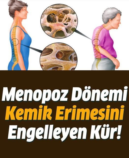 Kemik erimesi