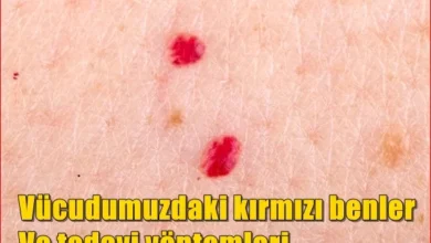 Vücudumuzdaki kırmızı benler ve tedavi yöntemleri